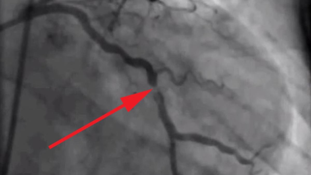 What is coronary thrombosis? Explained